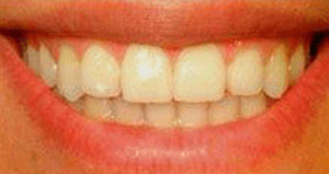 veneers_before_after