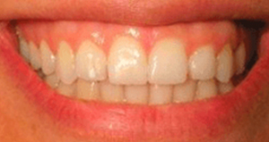 veneers_before_after