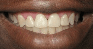 veneers_before_after