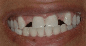 veneers_before_after