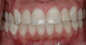 veneers_before_after