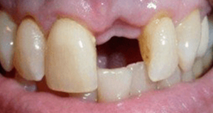 veneers_before_after