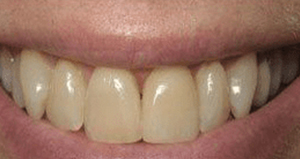 veneers_before_after