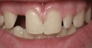 veneers_before_after