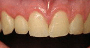 veneers_before_after